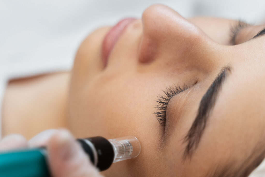 Czego nie wolno po mezoterapii mikroigłowej?