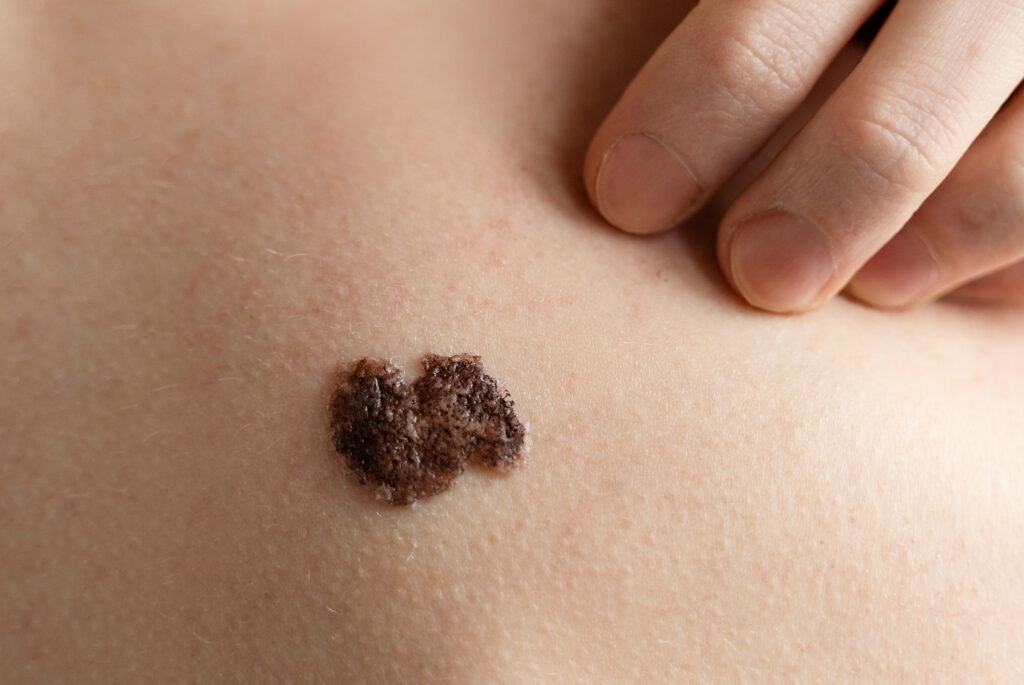 Jakie znamiona należy usunąć? Diagnostyka i leczenie zmian skórnych