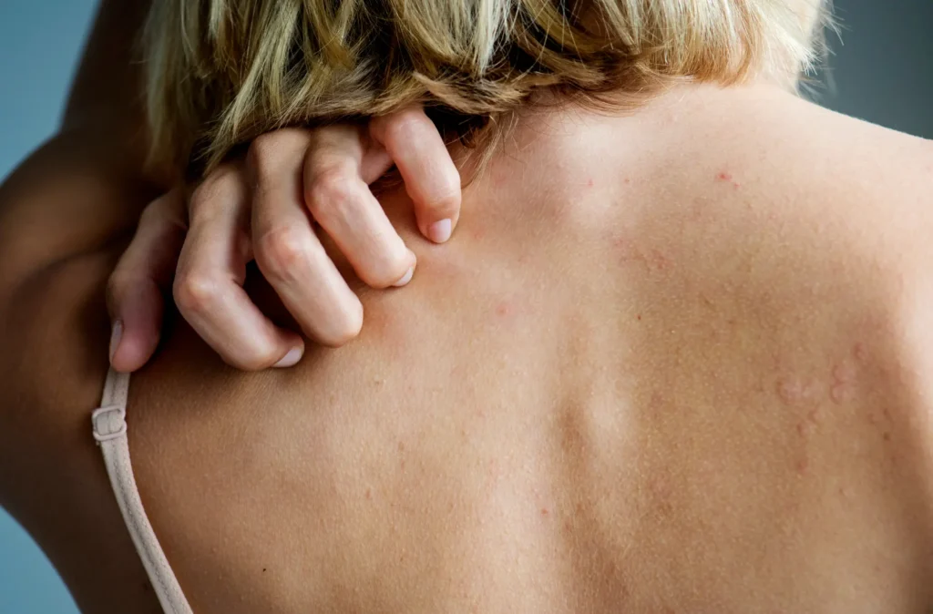 swędząca skóra bez wysypki dermatolog wrocław przyczyny